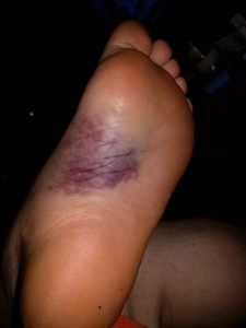 Lovely bruise on the base of my left foot.