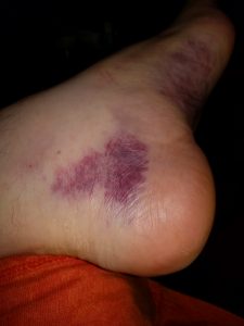 More bruising