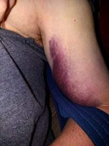 Bruise starting to develop nicely.